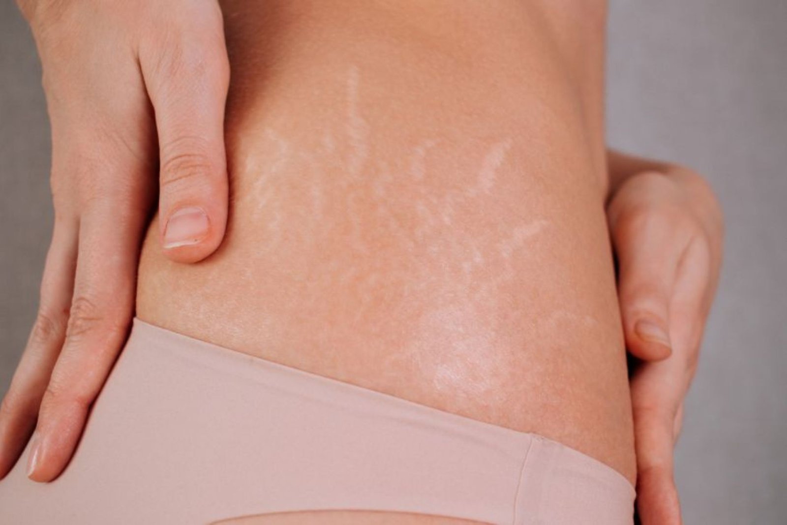 Tratamentos Corporais para Tratamento de Estrias