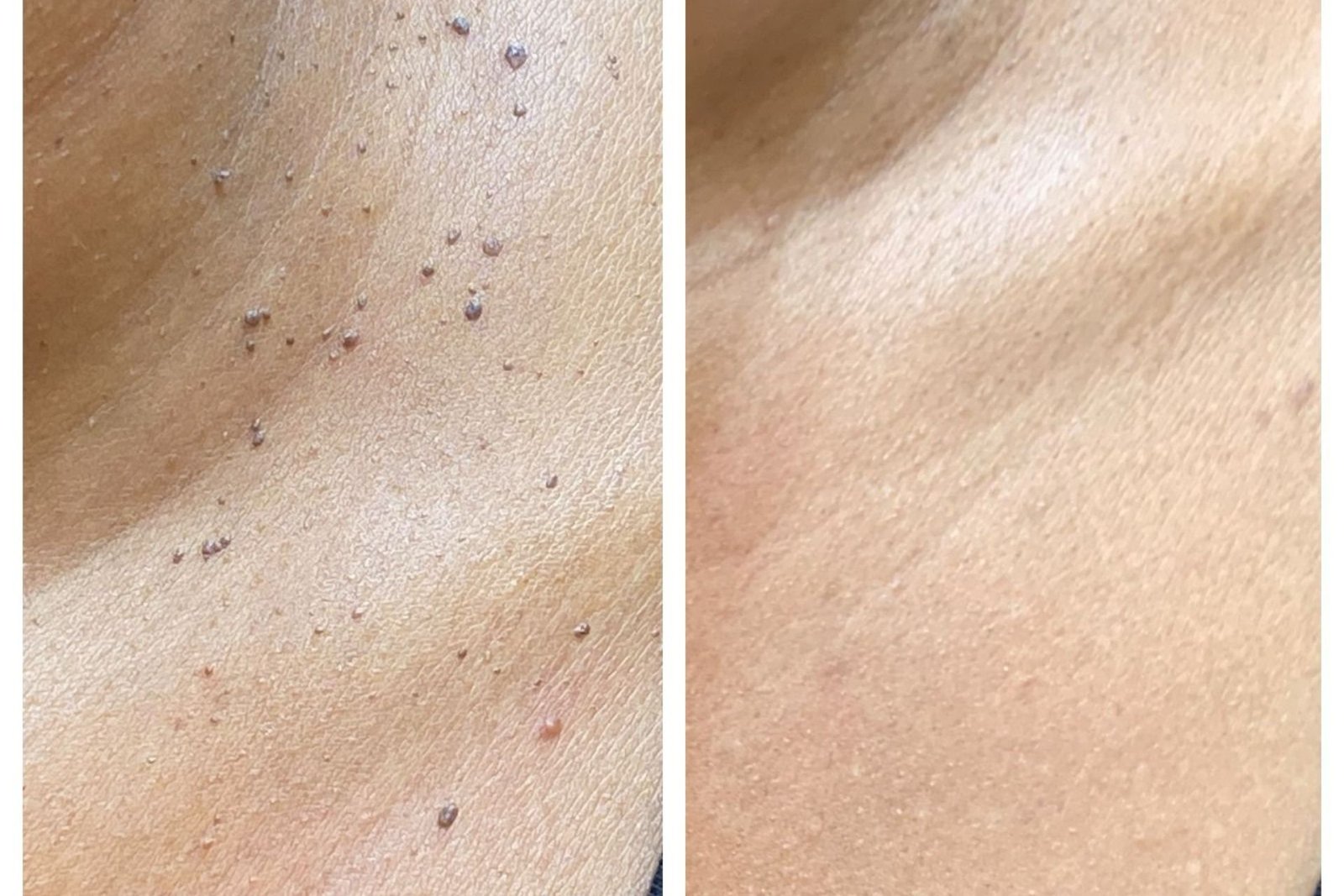 Tratamentos Corporais e Eletrocoagulação